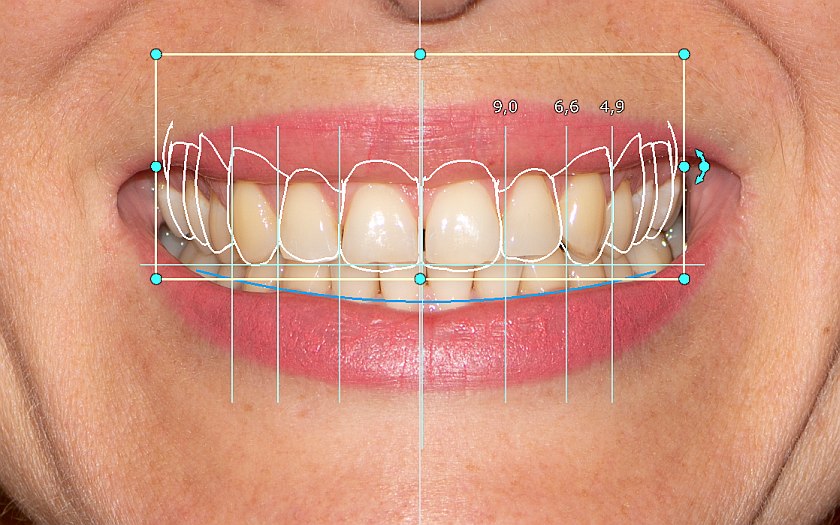 фото зубов и контуры новой улыбки
