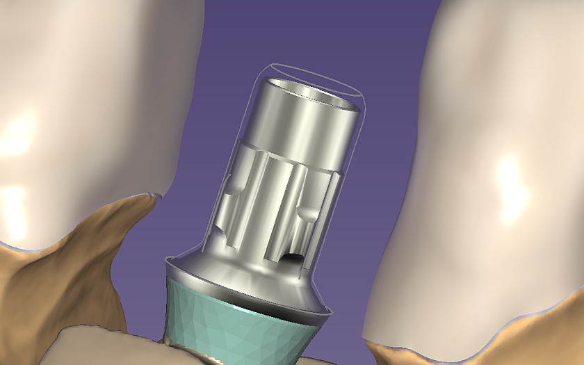 Straumann Tissue Level Implant hybrid superstructure