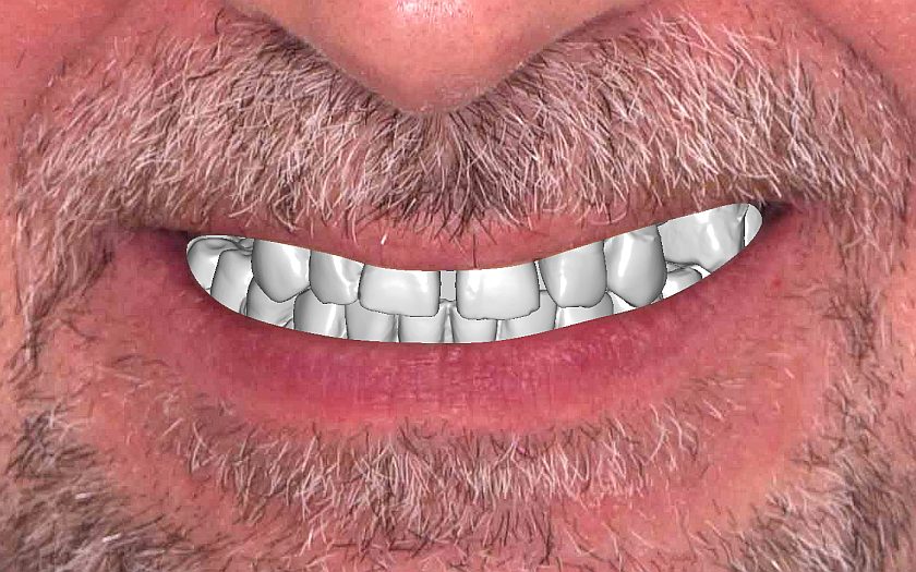 ситуация до планирования, фотография и модели челюстей