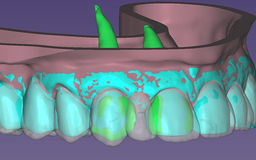 Отсутствие места в области 12 зуба